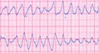 Heart rate - arhythmia